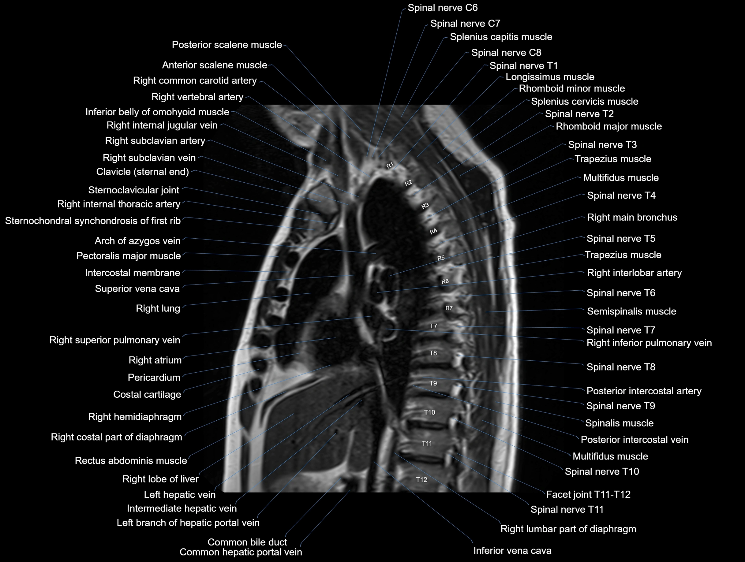 MRI chest (thorax) coronal  cross sectional anatomy 3T radiology  image-img-00001-00017.webp